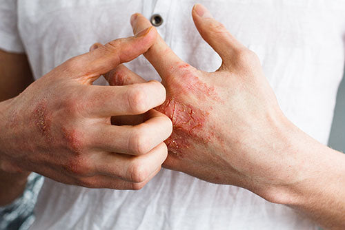 How to relieve itching during eczema crisis ?